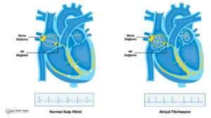 Atriyal fibrilasyon mekanizması