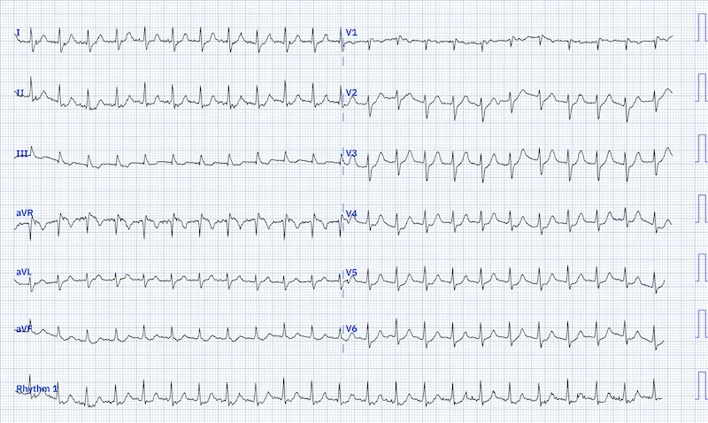 Taşikardi EKG'si (AVNRT)