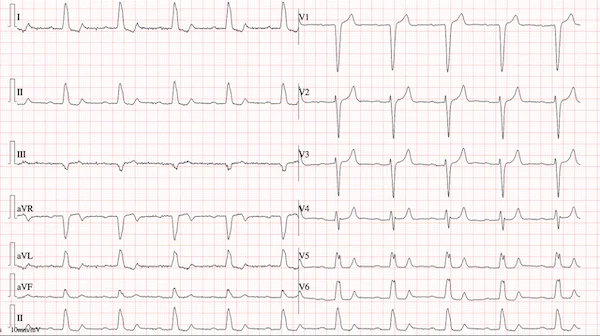 Sol dal bloğu ve 1. derece Kalp bloğu örnek EKG