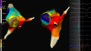 3 boyutlu ablasyon nasıl yapılır