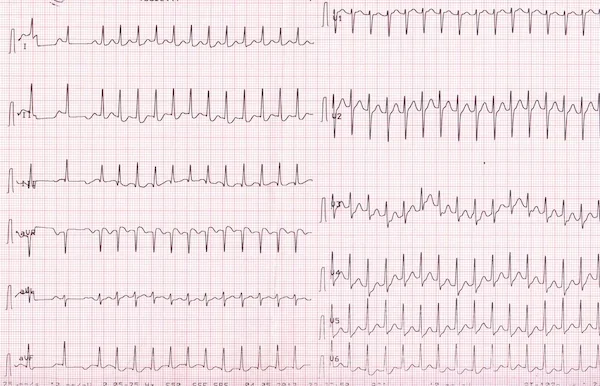 Supraventriküler Taşikardi SVT EKG örneği