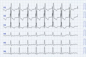 Taşikardi EKG Örneği