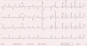 Ekstrasistol (Erken vuru)