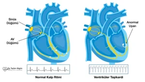 Ventriküler taşikardi mekanizması