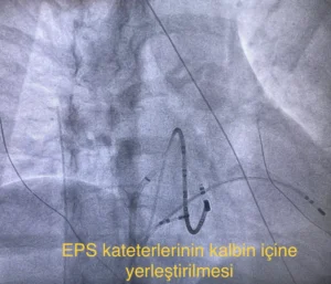 EPS kateterlerinin kalbin içine yerleştirilmesi