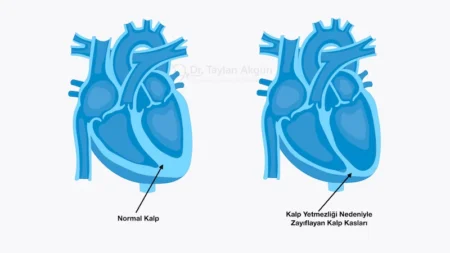 Kalp yetmezliği nedeniyle zayıflamış kalp kası