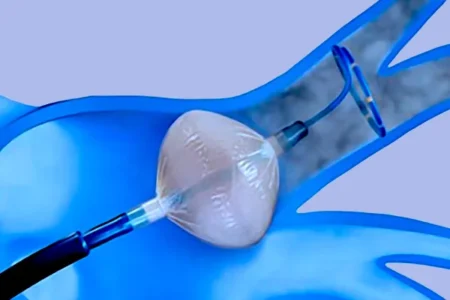 Soğuk Ablasyon (Kriyoablasyon)