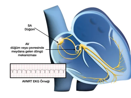 AVNRT Mekanizması ve EKG örneği