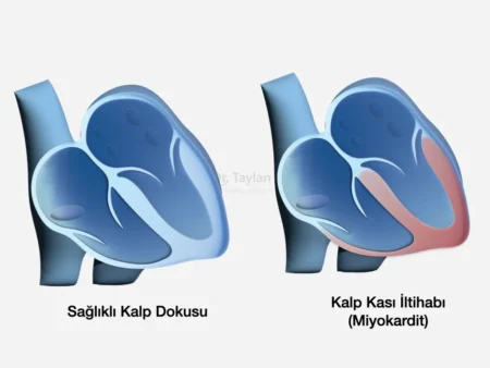 Kalp Kası İltihabı (Miyokardit)