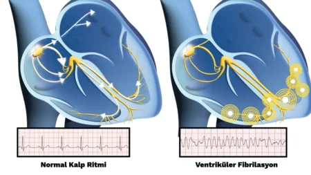 Ventriküler Fibrilasyon