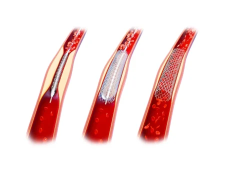 Anjiyo (Anjiyografi)