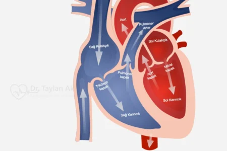 TAVİ (Transkateter aort kapak implantasyonu)