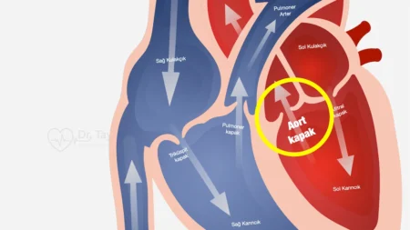 Aort Kapak Hastalığı