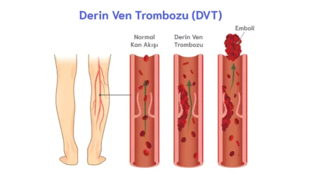 Derin Ven Trombozu (DVT)
