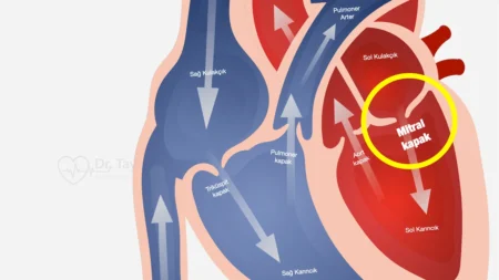 Mitral kapak hastalığı