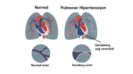 Pulmoner Hipertansiyon