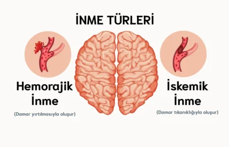 İnme (hemorajik inme ve iskemik inme)