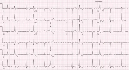 Atriyal flutter ablasyonu