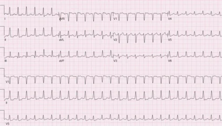 SVT Ablasyonu (AVNRT EKG'si)
