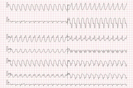 Ventriküler Taşikardi Ablasyonu