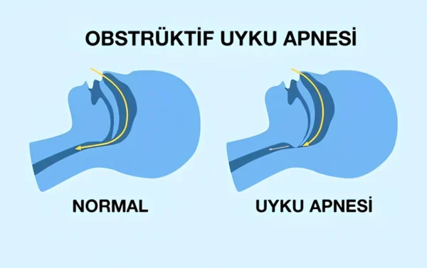 Obstrüktif Uyku Apnesi