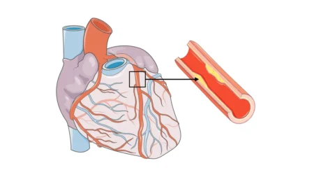 Anjiyoplasti ve Stent mi Bypass mı