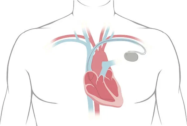 Kalp pili takıldıktan sonra nelere dikkat edilmeli